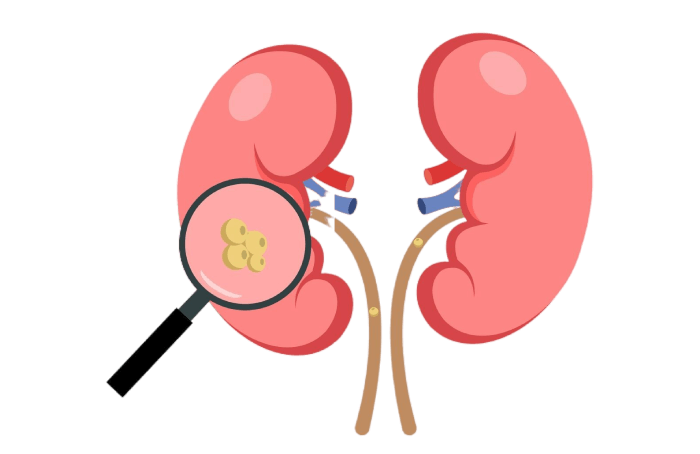 Diagnóstico y tratamiento de litiasis renal ofrecido por el Dr. Eduardo Cetina Pacheco: soluciones efectivas para tus problemas renales
